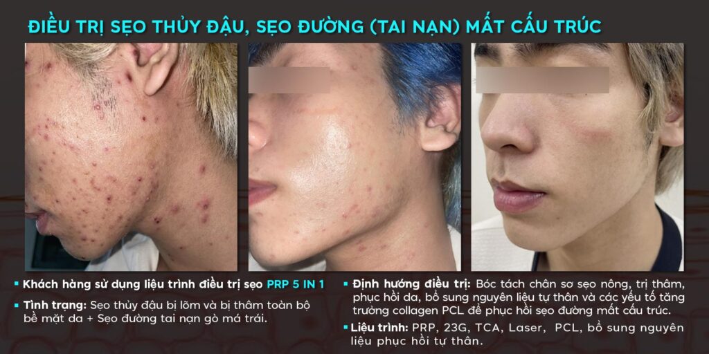 Review chi tiết dịch vụ trị sẹo tại Dr. Choice Clinic từ A đến Z 5 khach hang tri seo thuy dau dr choice