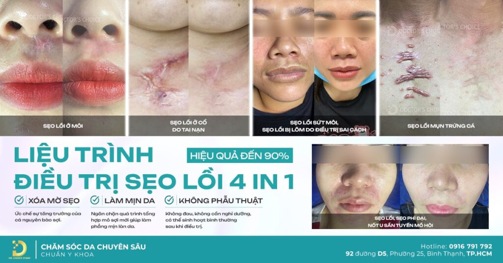 anh 1 tri seo loi 4 in 1 1