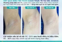 tri tham nach dr choice